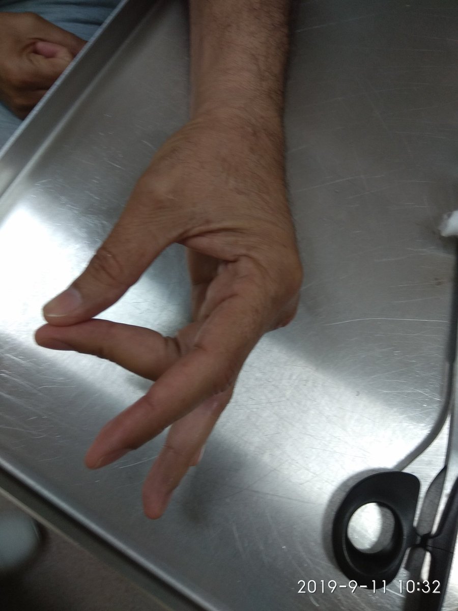 ds_reuben's tweet photo. An extensor tendon injury  of left middle finger zone 5 corrected under WideAwakeLocalAnaesthesiaNoTourniquet WALANT. Great extension and full finger flexion at4 weeks post-op. Kudos to Dr. Don Lalonde who taught me this technique. https://t.co/uFW7ih6Oxt