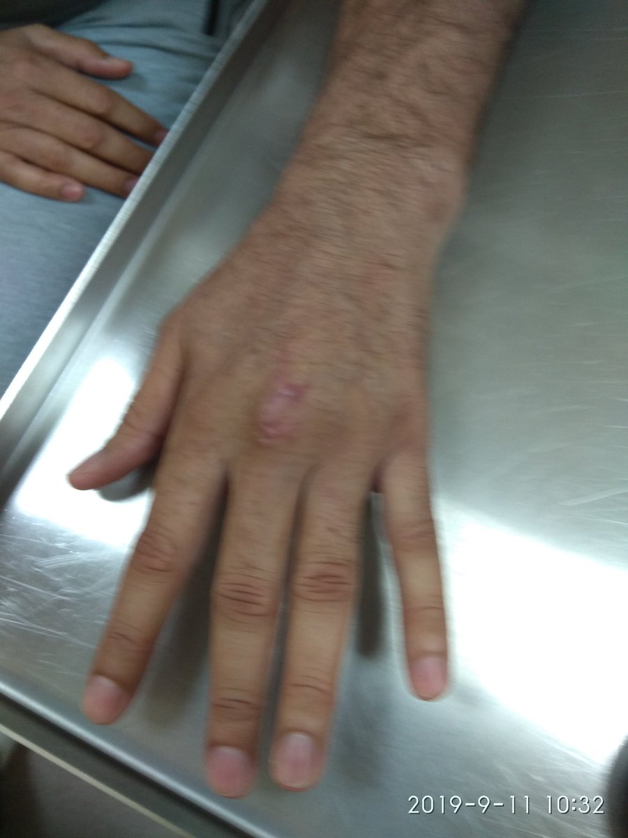 ds_reuben's tweet photo. An extensor tendon injury  of left middle finger zone 5 corrected under WideAwakeLocalAnaesthesiaNoTourniquet WALANT. Great extension and full finger flexion at4 weeks post-op. Kudos to Dr. Don Lalonde who taught me this technique. https://t.co/uFW7ih6Oxt
