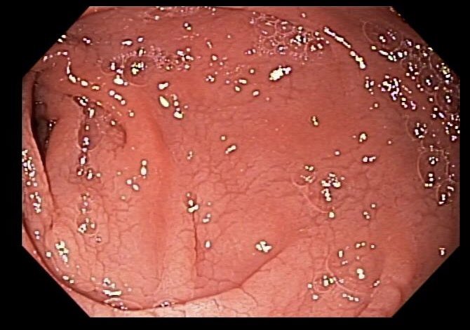 Why was this young man, whose duodenum is pictured here, ‘deferred’ from donating blood?

#FOAMed #FOAMim #FOAMgi