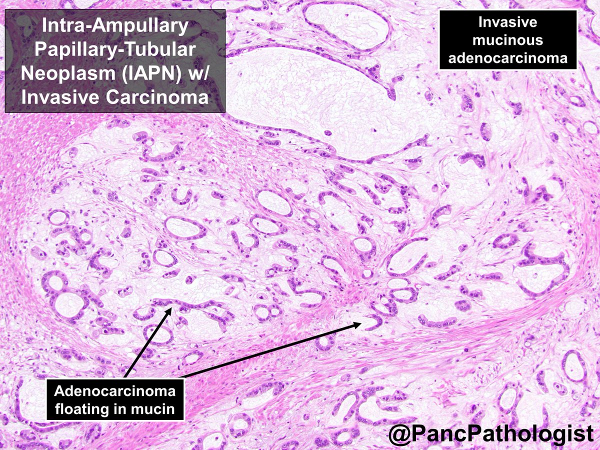 Intra-Ampullary Papillary-Tubular Neoplasm (IAPN): an intra-ampullary precursor to #AmpullaryCancer and correlate to Intraductal Papillary Mucinous Neoplasm (IPMN) associated w/ #PancreaticCancer, but different genetics. No KRAS/GNAS mut. #Pathology #GIPath #Ilovetogrosspancreata