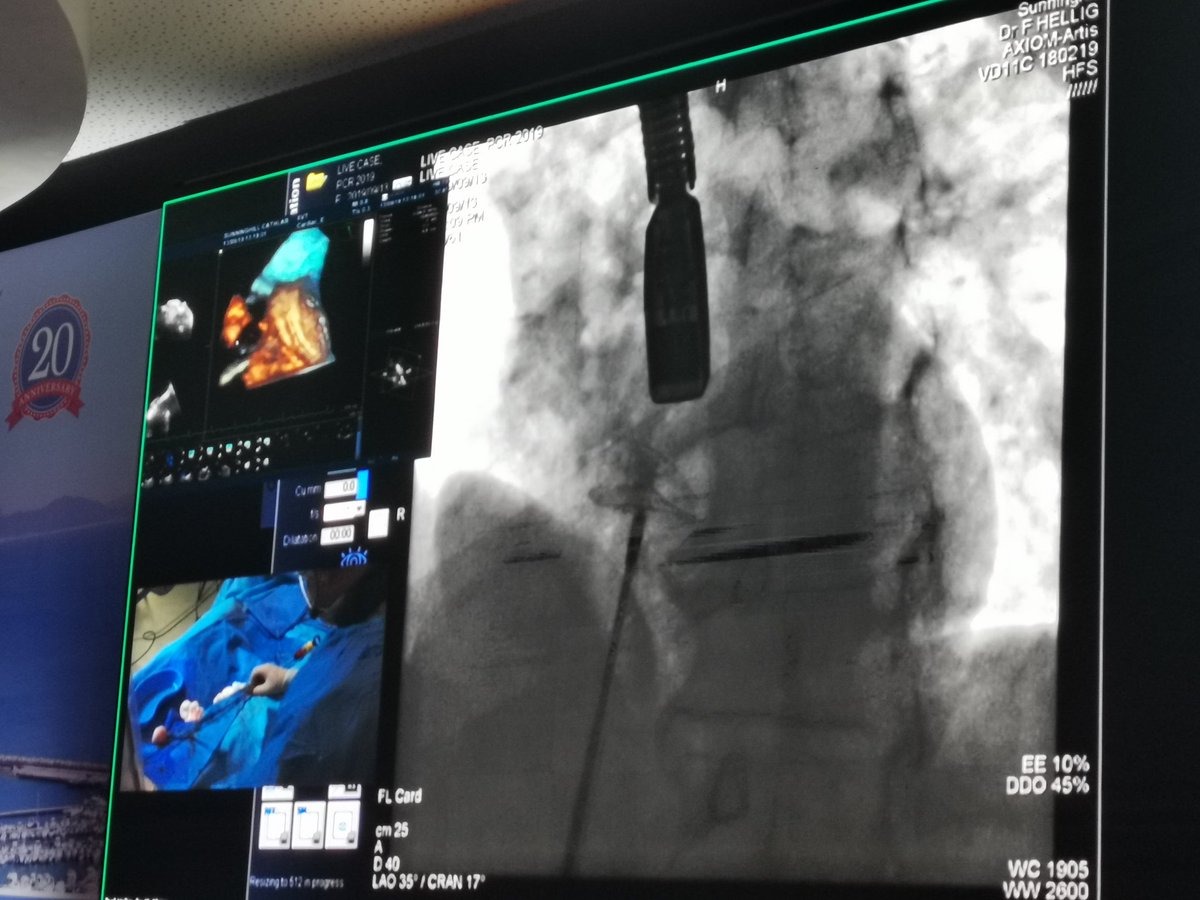 Sudanheartgroup's tweet photo. Day 2. Live case from Johannesburg. PFO Closure performed by Farrel Hellig using a 25 mm Occlutech occluder.
Facilitated by Awad Mohd
#PFO #Occlutech #PAFCIC
@Awad_AbdallaMoh https://t.co/1EZDiK5NfS