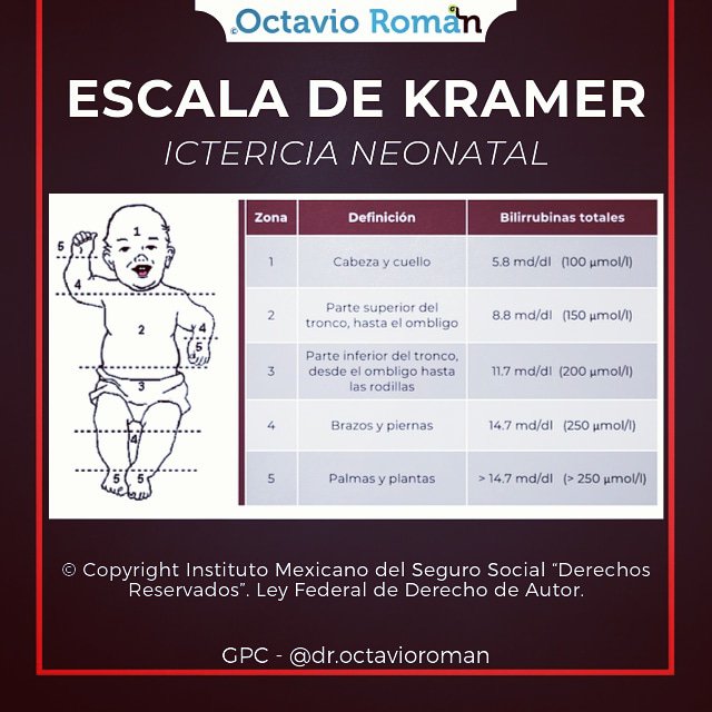 droctavioroman's tweet photo. La escala de Kramer es pregunta ENARM, complementa con otras fuentes.
#repaso #repasoenarm #enarm  #enarm2019 #repasomédico #medstudent #médico #udg #cucs #cuc #cualtos #cusur #cutonala #medicinaudg #flashcard #octavioroman  #GPC #medicoblasto #kramer #ictericia #bilirrubina https://t.co/eGjH9uvMxx