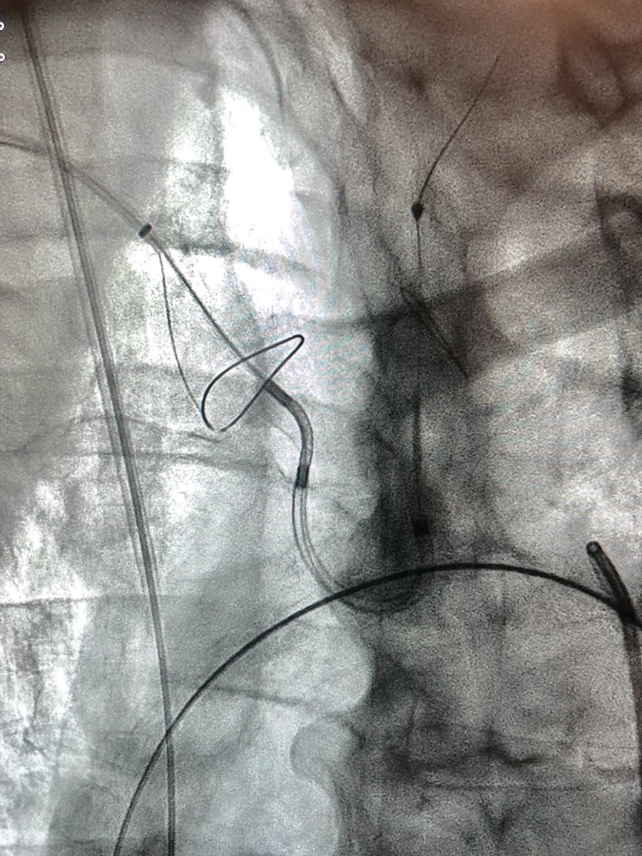 AndreasRck2's tweet image. Successful live case transmission from @KarolinskaUnsju to PAFCIC conference in Tunisia today. #tavr using #Acurate, LV wire pacing, #sentinel neuroprotection. Honored to be followed by Alain Cribier in the program. Operators Nawzad Saleh and myself.