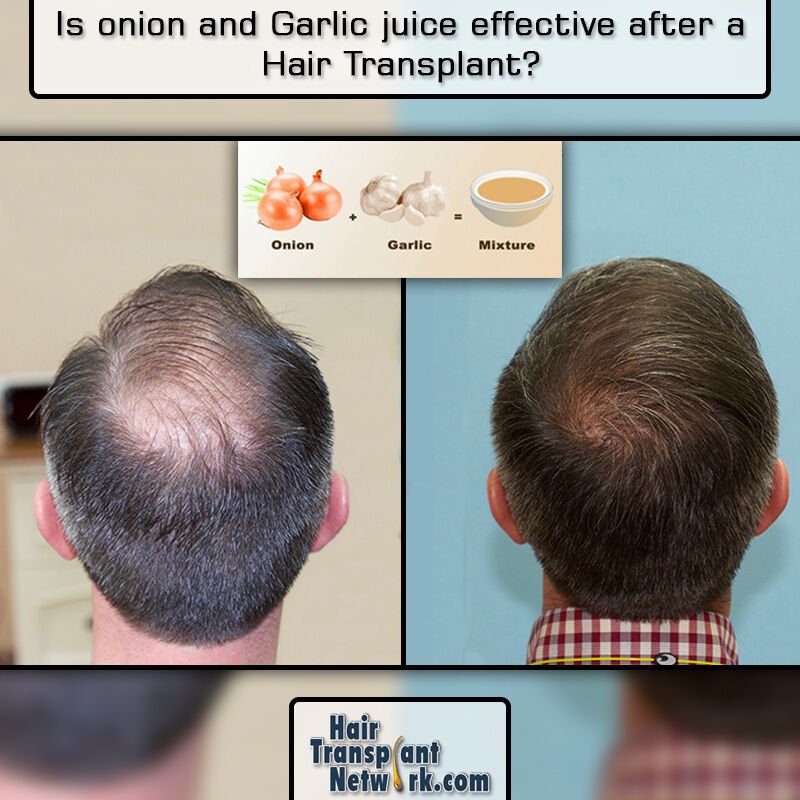 How many days onion takes to regrow hair? - Quora