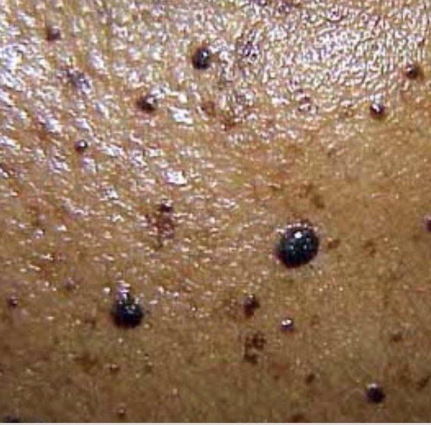 171Salon's tweet photo. We now offer Advanced Electrolysis at 171. An immediate and effective way to remove, broken capillaries, skin tags, cherry spots, dermatitis papulosa nigra, aswell as other skin blemishes. Ask reception about a free consulation. Offer price £45.00 normally £60.00. https://t.co/YI54Sx2aio
