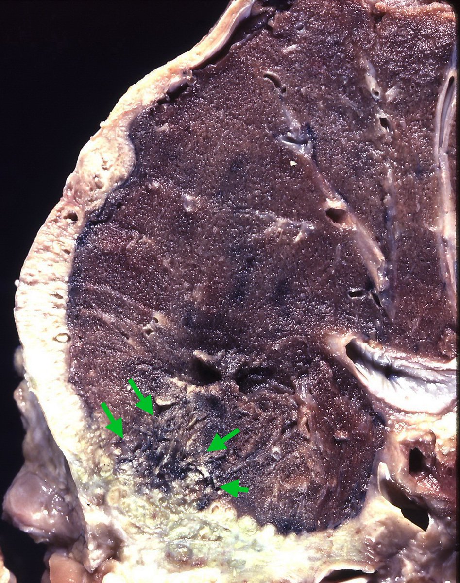 can pet scans detect cancer