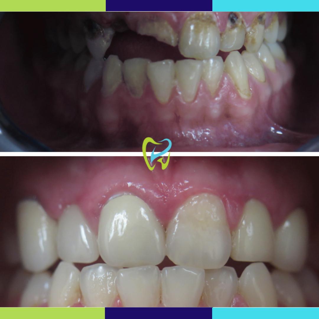 Ready for a smile makeover? We can help! Our dental implants and veneers can give you the smile you deserve. #Veneers #DentalImplants