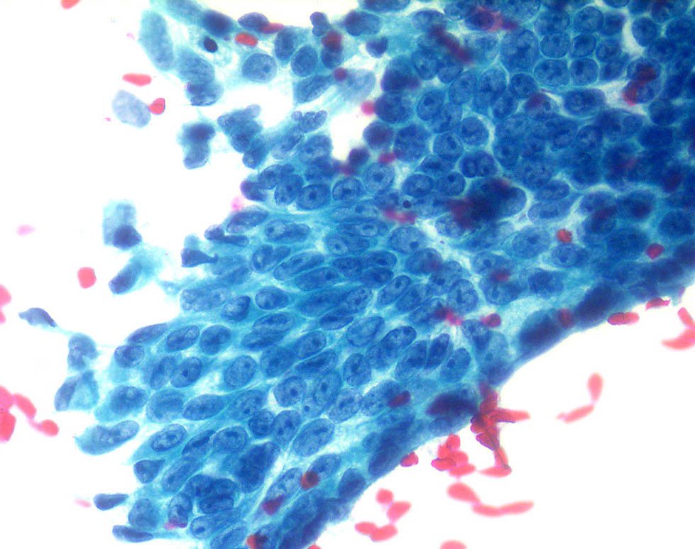 risk factors for malignant pleural mesothelioma