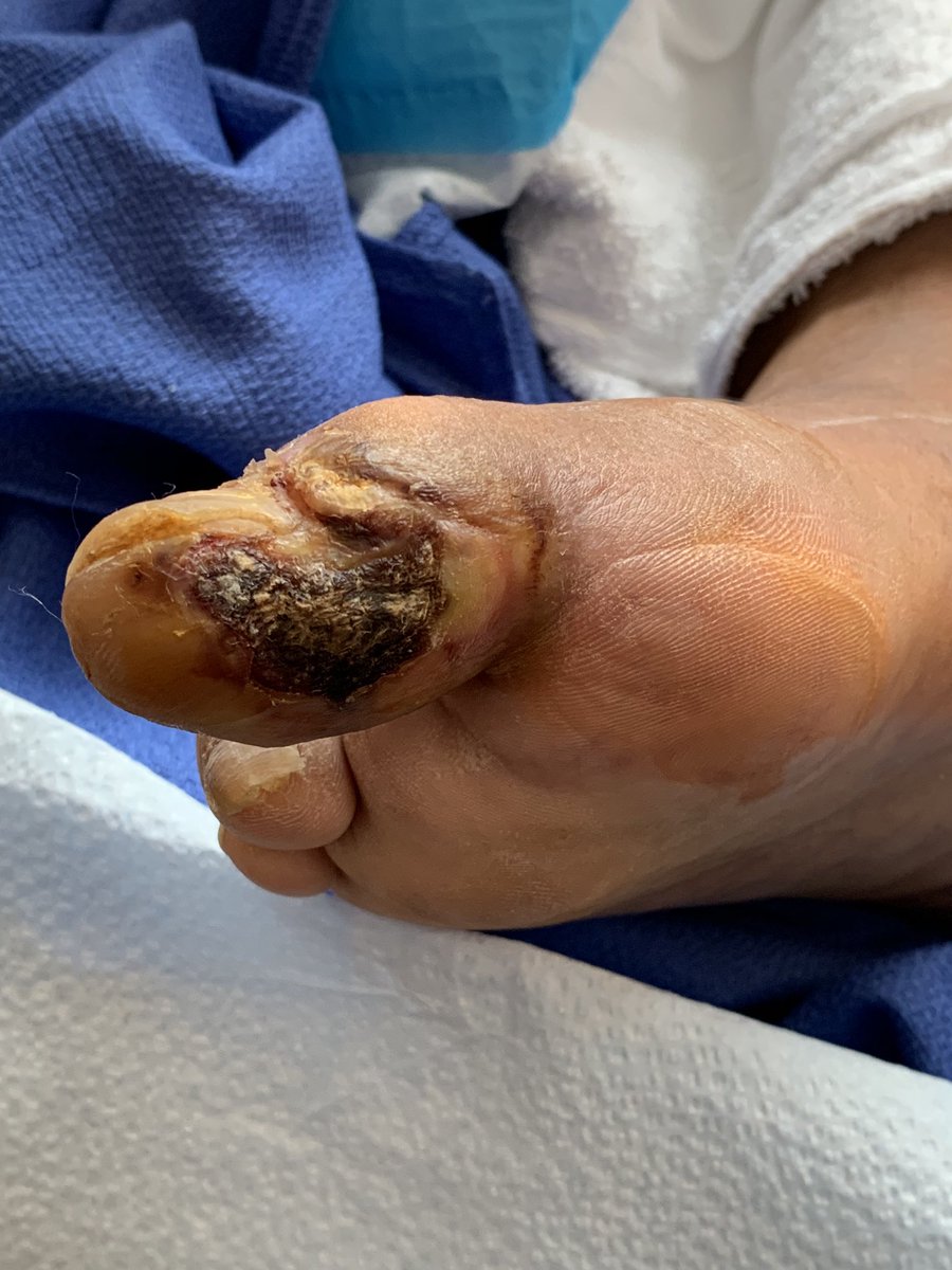 Finally opened my new office consult space <a href="/AMI_Vascular/">Vascular Institute of Atlantic Medical Imaging</a> and these are my first two consults. This is gonna be fun 😏 #CLIFighters @MdPetruzzi <a href="/SDhandMD/">Sabeen Dhand</a> @Mustapja <a href="/LessneVIR/">Mark Lessne, MD</a> <a href="/drsavealimb/">Paul Michael MD, FSCAI</a> <a href="/kmadass/">Kumar Madassery</a> <a href="/TimYatesMD/">Tim Yates</a> @VV_VIRNIR <a href="/omarsaleh66/">Omar Solana MD NFT</a> <a href="/SriniTummala/">Srini Tummala MD FSIR FSVM</a> <a href="/ABrandisMD/">Aaron Brandis</a>