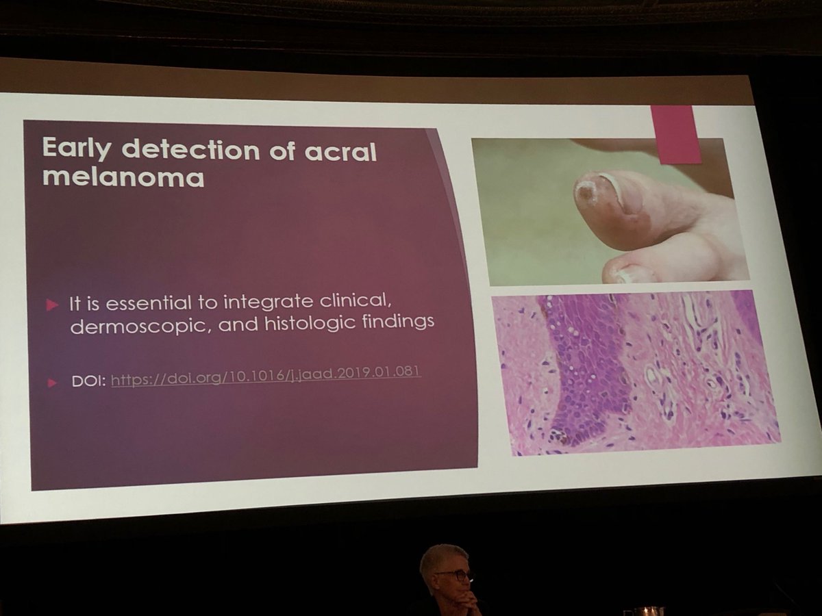 AllisonLarsonMD's tweet photo. Dirk Elston wishes us a “tips of the rete” (the #dermpath version of ‘top of the morning’) and gives pearls on acral melanoma: look out for this “arch enemy” (when pigment moves toward the arch) #2019APD #dermtwitter ⁦@JAADjournals⁩ https://t.co/0yhx6zxJYx