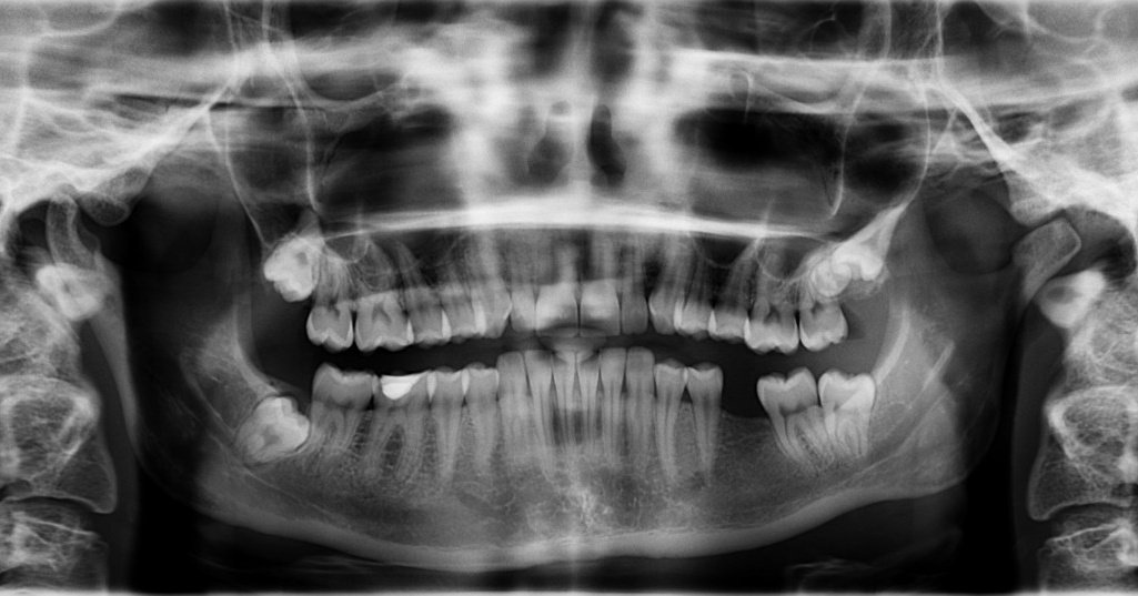 Dentaloffice's tweet photo. Concerns about radiation exposure during X-rays have been a concern for countless dental patients for decades. Smile Esthetics uses advanced digital technology to take X-rays that reduce exposure by 80% to make worries about radiation a... https://t.co/rq2D9db0JD