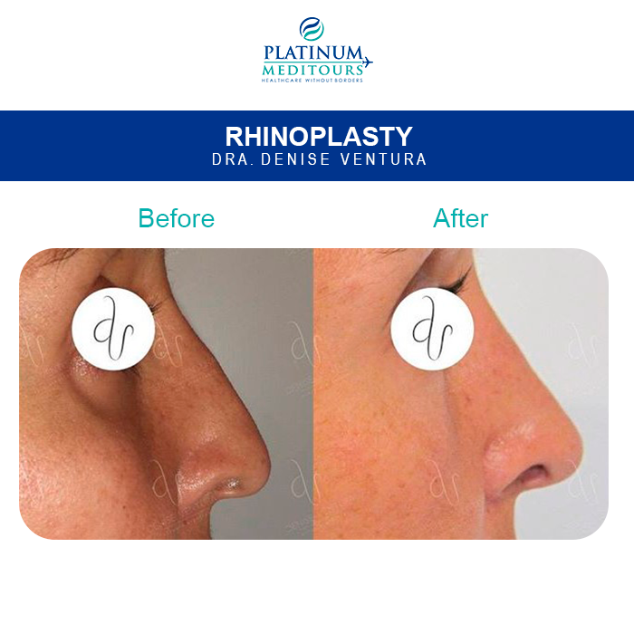 PMeditours's tweet image. 👏👏Gorgeous result #Rhinoplasty by Dra. Denise Ventura
💰Pay 20 to 50% LESS than in #USA 🇺🇸
Get a free QUOTE NOW👇👇