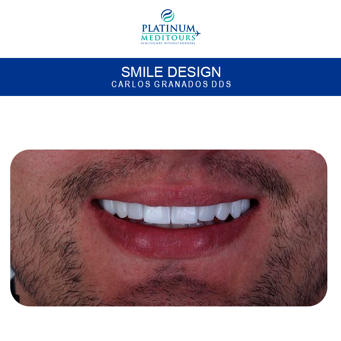 PMeditours's tweet image. #beforeandafter #Veneers are minimally invasive #dental aesthetics treatment, ideal for improving the appearance of teeth ( color, shape, size ) and improve the smile.
Get a free QUOTE NOW👇👇
platinummeditours.com