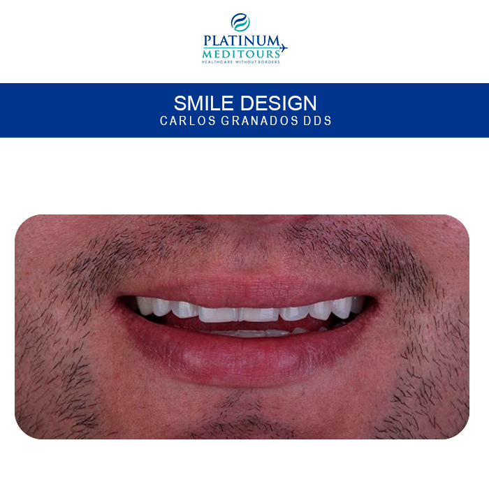 PMeditours's tweet image. #beforeandafter #Veneers are minimally invasive #dental aesthetics treatment, ideal for improving the appearance of teeth ( color, shape, size ) and improve the smile.
Get a free QUOTE NOW👇👇
platinummeditours.com