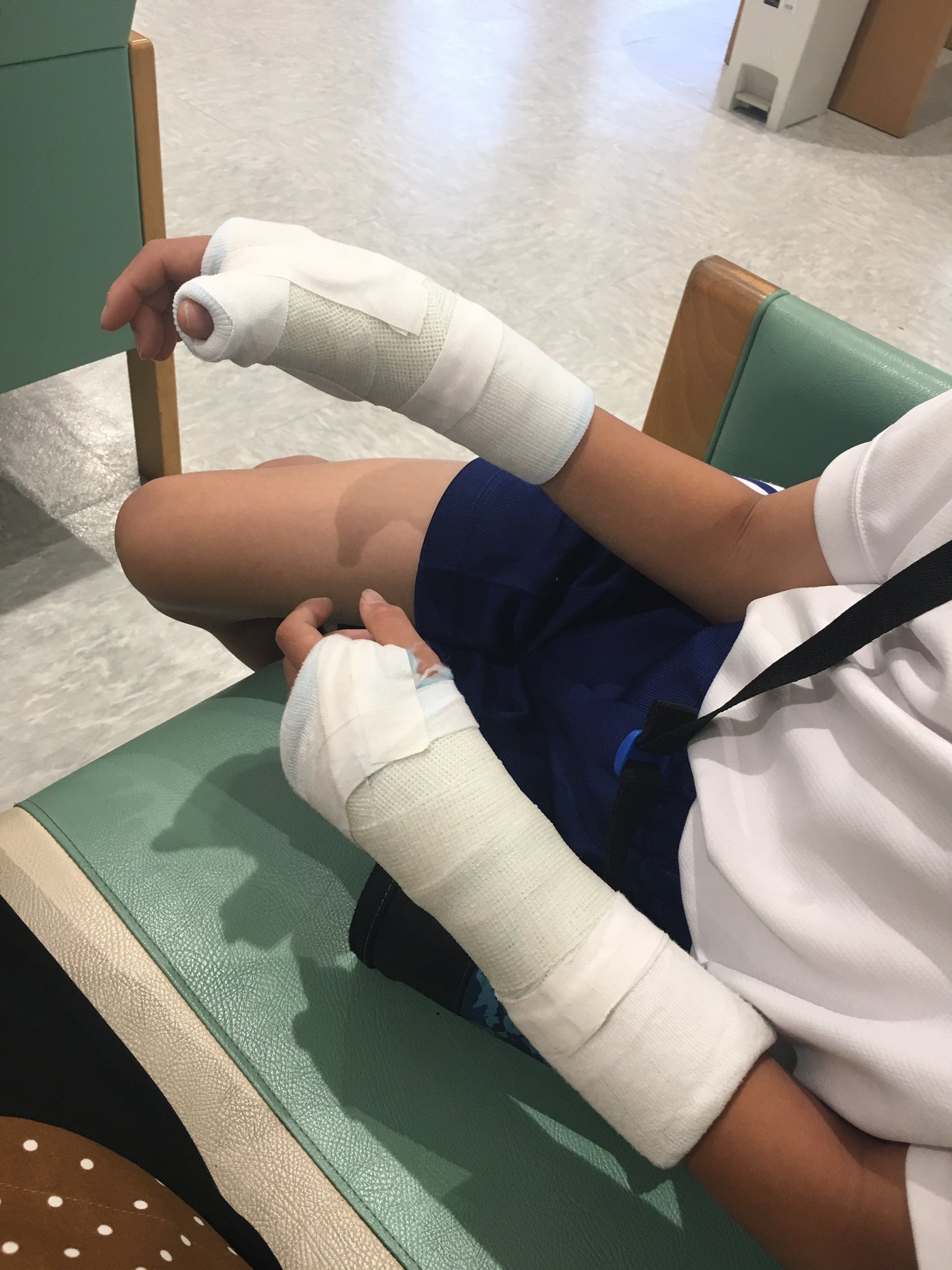 まいまい Al Twitter 子供がバスケで両手骨折 両手ともギプスなんて見たことない 不自由だけどガンバレ 両手骨折 両手ギプス T Co Djoi2exbvo Twitter