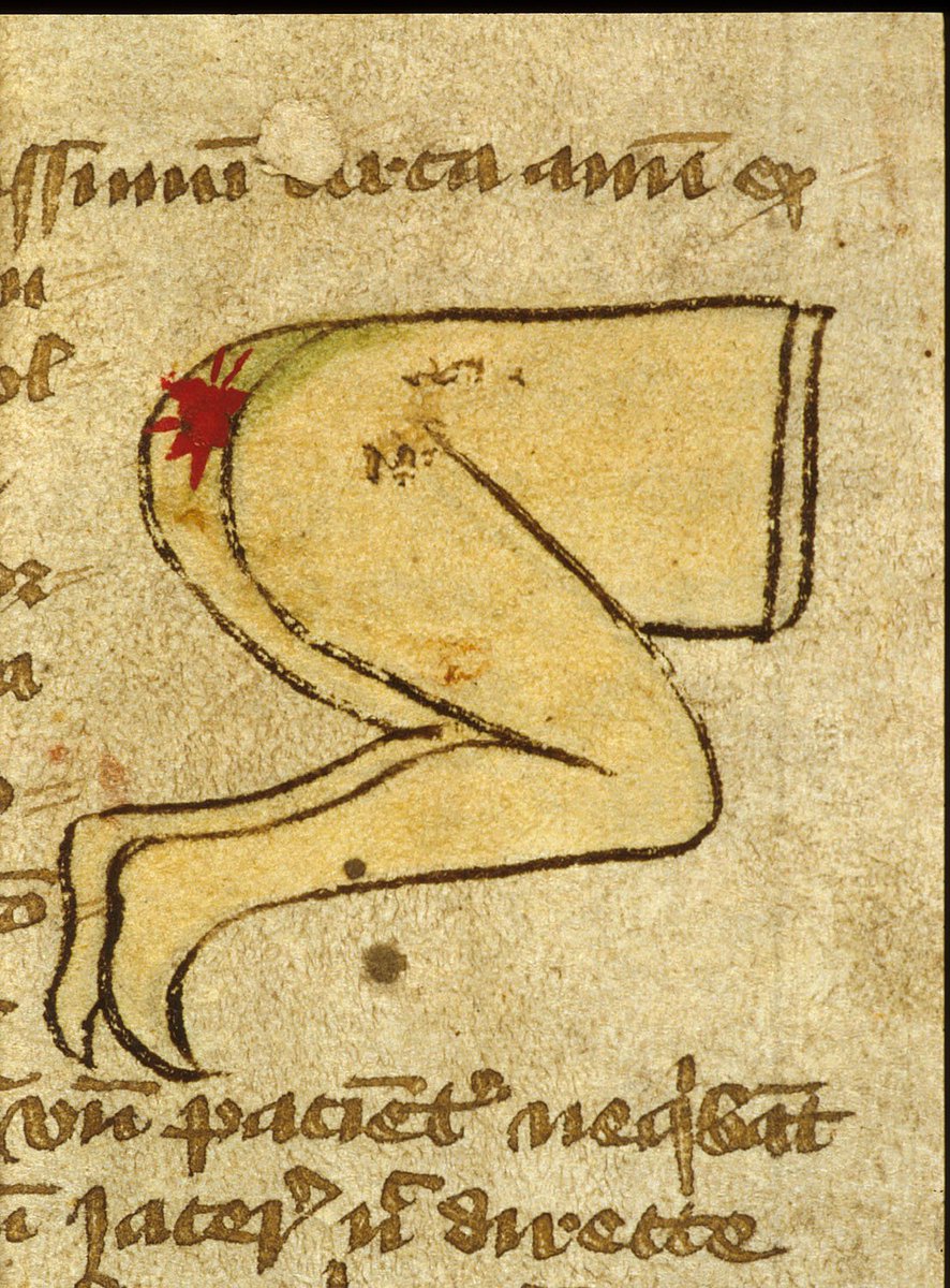 Some butts need a hand(these are medical procedures, so LOOK AWAY if you're squeamish)(BL, MS Harley 1585 f. 9; BL, MS Sloane 3844 f. 15v; BL, MS Sloane 1975 f. 93) #MedievalTwitter