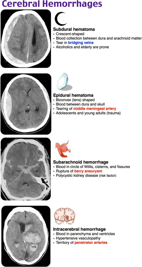 EM_Capsules's tweet photo. Types of Intracranial hemorrhages 🧠🌟
#EM_capsules https://t.co/pDxa24GE1a