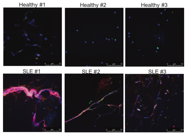 VirusesImmunity's tweet photo. A new study by @maria_tokuyama is on @biorxivpreprint! She found that many people have IgG against human endogenous retrovirus K envelope. In #lupus patients, that IgG can form #immunecomplex with env to stimulate #neutrophils to release #NETs. #SLE #ERV https://t.co/UcBVQJVLZq https://t.co/1PFoxLBahd