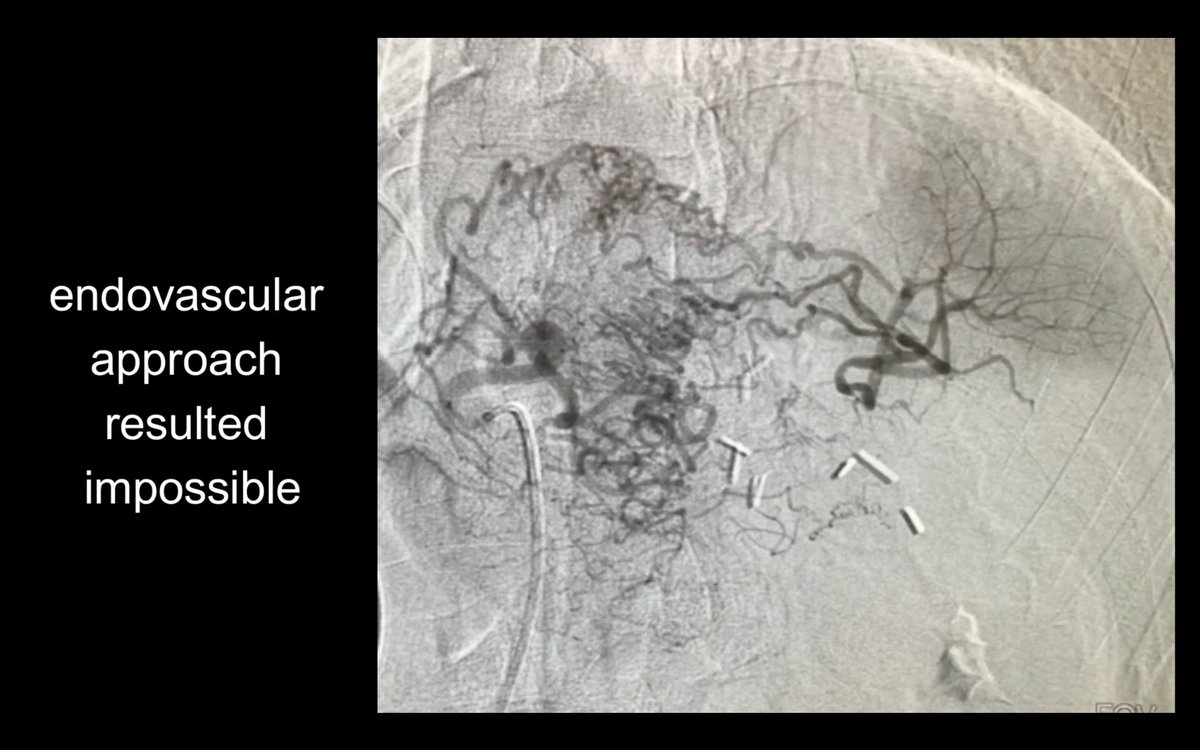 interventistica's tweet photo. Embolizzazione percutanea di pseudoaneurisma gastrico
https://t.co/EVJTixgdaD https://t.co/3FGJewrqSt