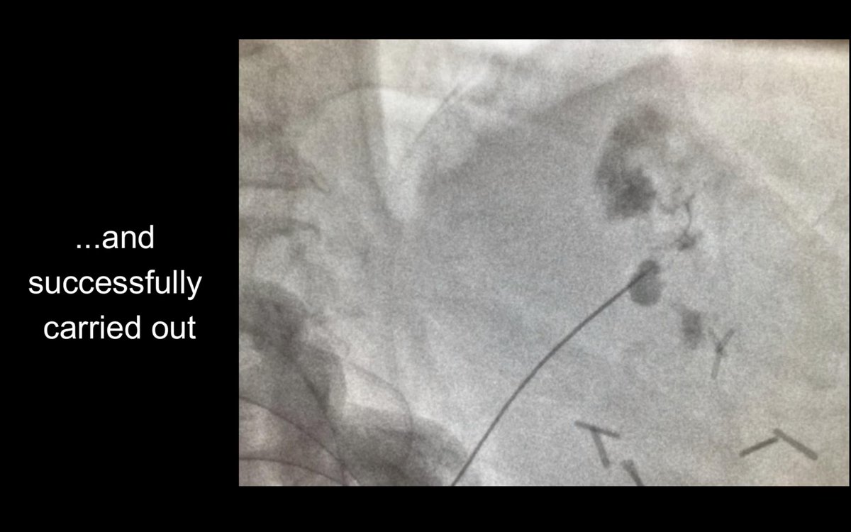 interventistica's tweet photo. Embolizzazione percutanea di pseudoaneurisma gastrico
https://t.co/EVJTixgdaD https://t.co/3FGJewrqSt