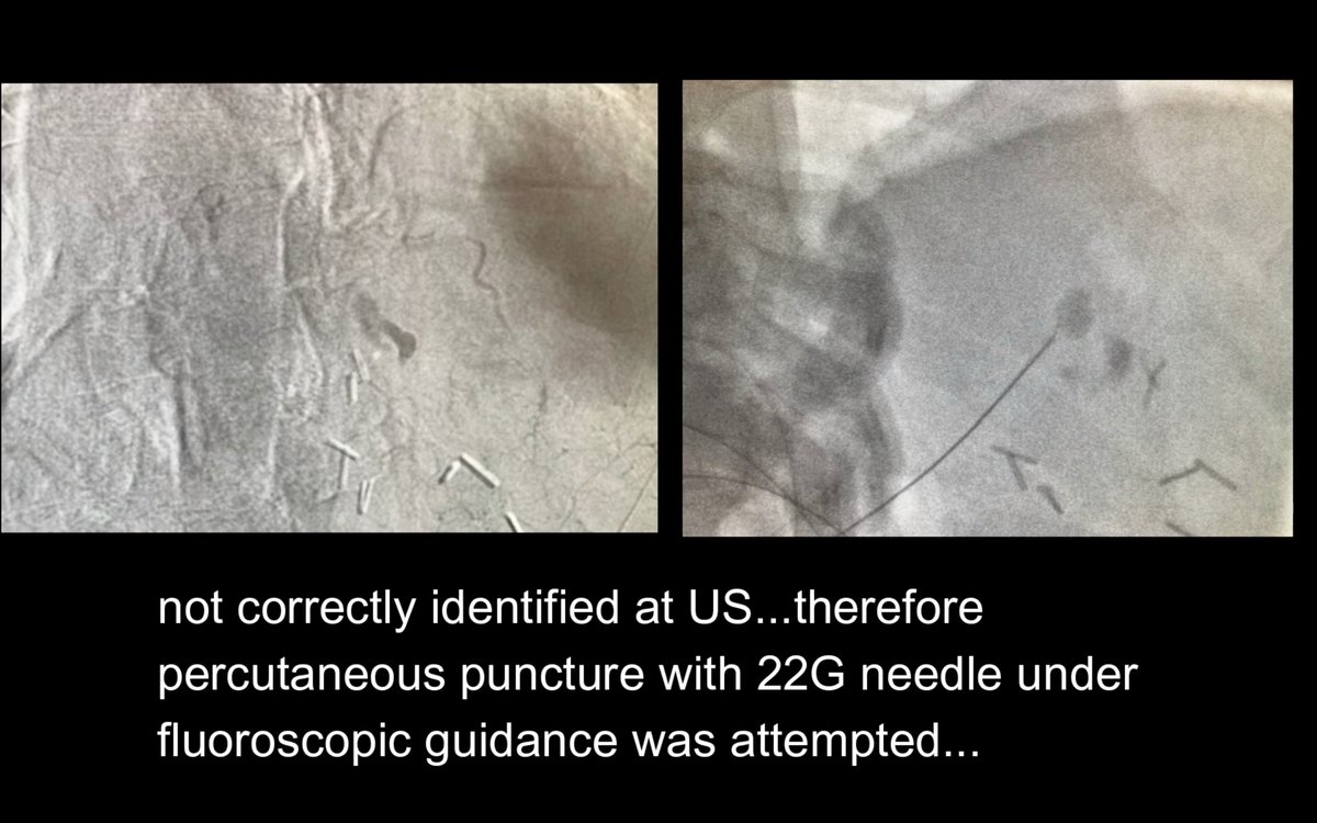 interventistica's tweet photo. Embolizzazione percutanea di pseudoaneurisma gastrico
https://t.co/EVJTixgdaD https://t.co/3FGJewrqSt