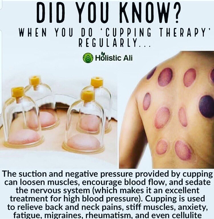 keytocure's tweet photo. Benefits of cupping. #holistictherapy#naturaltreatment #cupping #migraine #relaxation #leeds #bradford #keytocure #muscleache #cleanse #detox #westyorkshire #sunnah #islam #painrelief #massage #sportsmassage #deeptissuemassage #mechanicalmassage #male #female #therapists #hijama https://t.co/KVgiWHHFdr