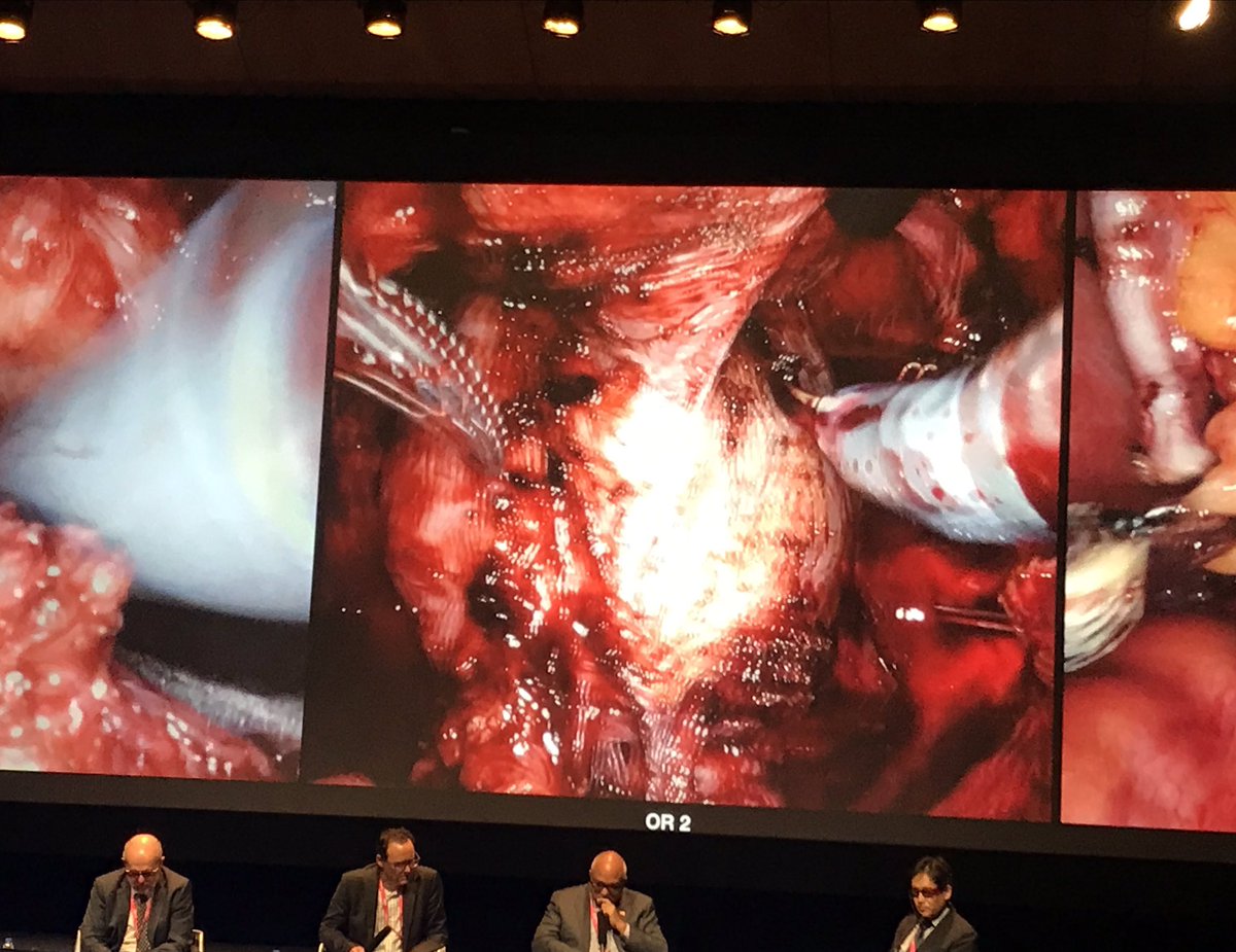Paolo Dell'Oglio (@paolo_delloglio) on Twitter photo Retzius-sparing robot-assisted radical prostatectomy. Live surgery at ERUS 2019 meeting. <a href="/ERUSrobotics/">ERUS Robotic Urology</a> <a href="/aldomassimo10/">Aldo Bocciardi</a> <a href="/agalfano/">Antonio Galfano</a> <a href="/ospniguarda/">Ospedale Niguarda</a> Retzius-sparing robot-assisted radical prostatectomy. Live surgery at ERUS 2019 meeting. <a href="/ERUSrobotics/">ERUS Robotic Urology</a> <a href="/aldomassimo10/">Aldo Bocciardi</a> <a href="/agalfano/">Antonio Galfano</a> <a href="/ospniguarda/">Ospedale Niguarda</a>