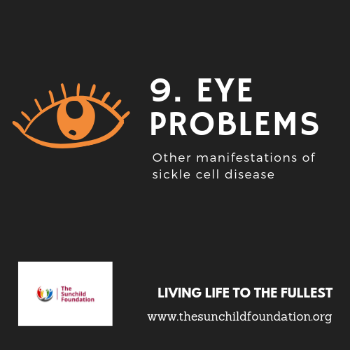 Sunchild_NG's tweet photo. OTHER MANIFESTATIONS OF SCD
No 9. Eye problems:

Recurrent blood vessel blockage in the tiny vessels of the eyes can lead to damage; Many times unnoticeable until you have a thorough eye examination. https://t.co/5gZIC2YMsK