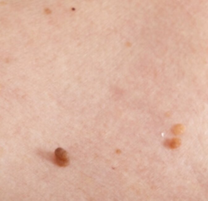 171Salon's tweet photo. Advance Electrolysis Special offer price £45.00 now £60.00. An immediate and effective way to remove, broken capillaries, skin tags, cherry spots, dermatitis papulosa nigra, aswell as other skin blemishes. Call us today to ask about a free consulation with our experts ♥️ https://t.co/5AXebUJDH4