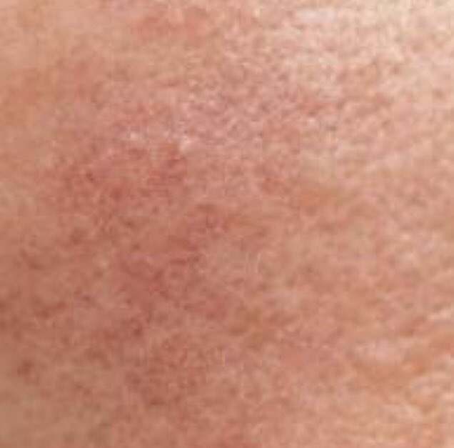 171Salon's tweet photo. Advance Electrolysis Special offer price £45.00 now £60.00. An immediate and effective way to remove, broken capillaries, skin tags, cherry spots, dermatitis papulosa nigra, aswell as other skin blemishes. Call us today to ask about a free consulation with our experts ♥️ https://t.co/5AXebUJDH4
