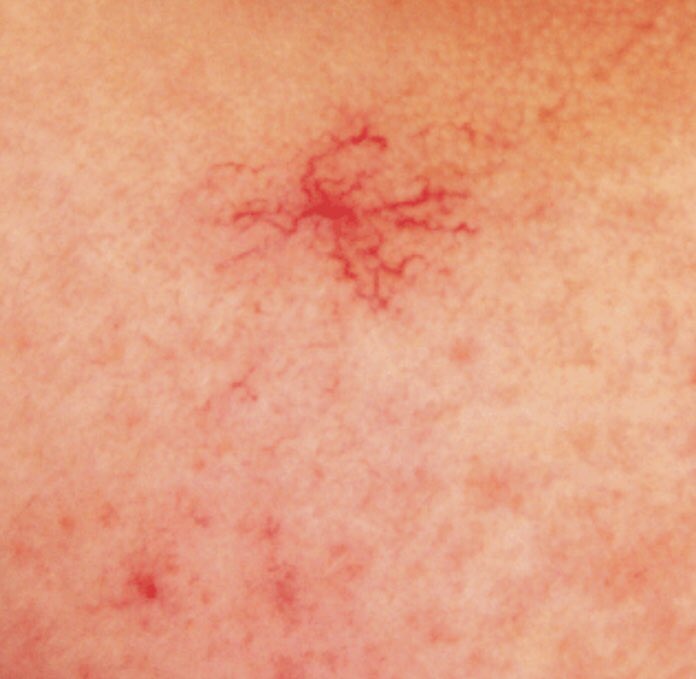 171Salon's tweet photo. Advance Electrolysis Special offer price £45.00 now £60.00. An immediate and effective way to remove, broken capillaries, skin tags, cherry spots, dermatitis papulosa nigra, aswell as other skin blemishes. Call us today to ask about a free consulation with our experts ♥️ https://t.co/5AXebUJDH4