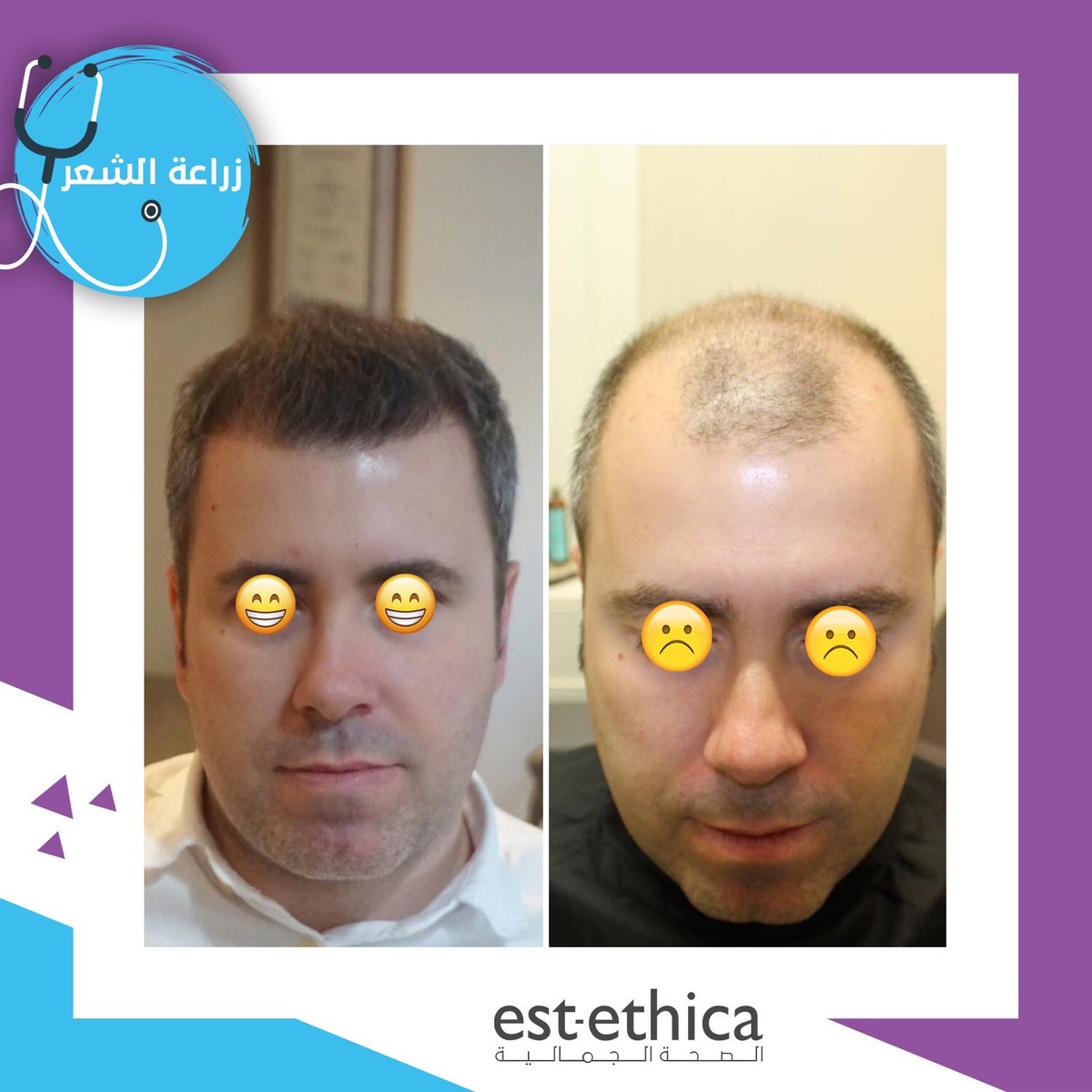mediogluar's tweet photo. نتائج عملية زراعة الشعر

#زراعة_شعر #تقنية_لاقتطاف #قلم_تشوي #قلم_السفير #اقتطاف #بيركوتان #اسطنبول #تركيا #تقنية_بيركوتان #hair #hairtransplant #turkey #istanbul https://t.co/lP4IYsQW1R