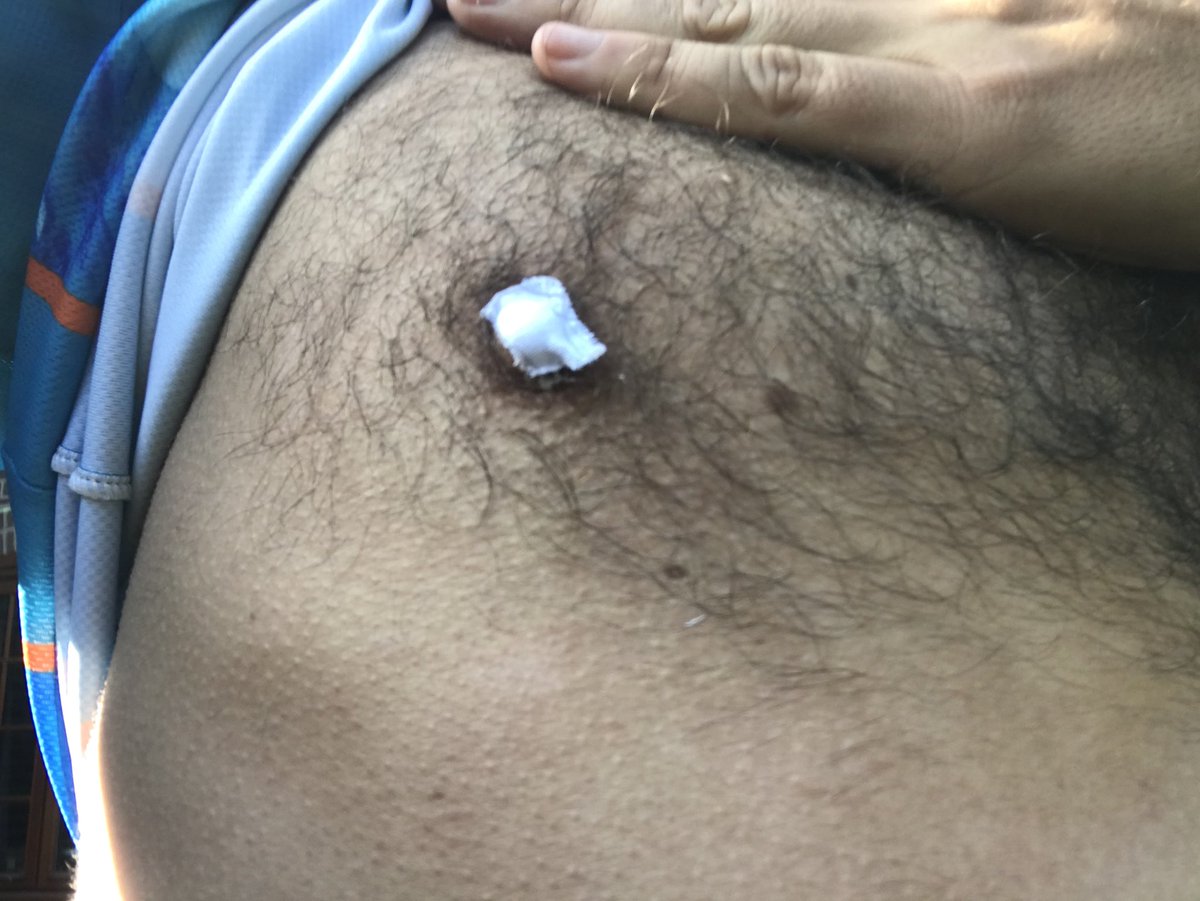 montythemole's tweet photo. Not had update on #bleedingnipples for while. After nearly passing out from blood loss during Tuesday marathon I tried Strappal Hypoallergenic Zinc Oxide Tape for today’s sweaty 15 miler. Worked a treat. Someone on here recommended it - it’s looking good so far! Gratuitous photo- https://t.co/9kAlPTtAQT