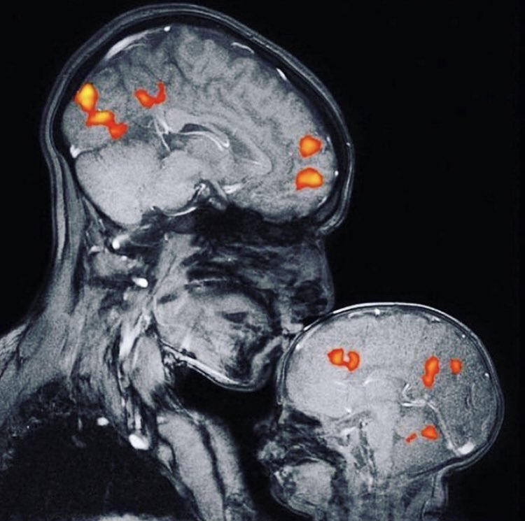 brainlab_mcgill's tweet photo. This is the world's first #mri showing a mother's and child's bond!
#family #love #neuroscience #brain_science https://t.co/Vikl8xRj33
