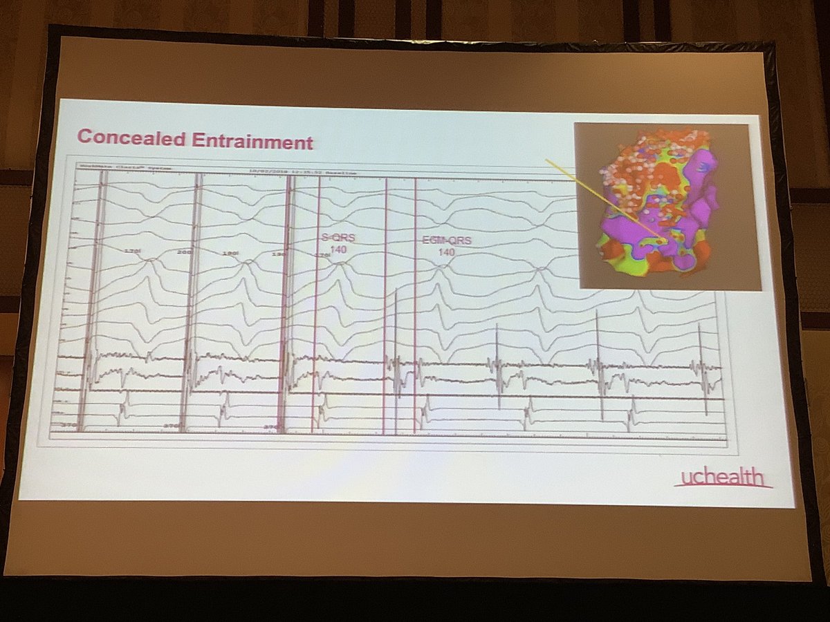 DebbeMcCall's tweet image. #COArrhythmia2019 Case Presentations from the Front Lines: Techniques and Endpoints for #Ablation of Ventricular Tachycardia #VTach - Ethan Ellis [EE] @uchealth