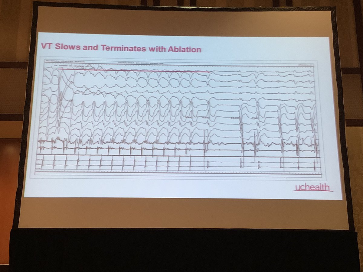 DebbeMcCall's tweet image. #COArrhythmia2019 Case Presentations from the Front Lines: Techniques and Endpoints for #Ablation of Ventricular Tachycardia #VTach - Ethan Ellis [EE] @uchealth