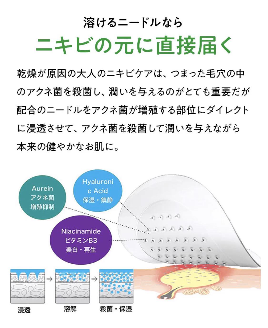 ニキビが出来たらコレを貼るとあっという間におさまるらしい！！