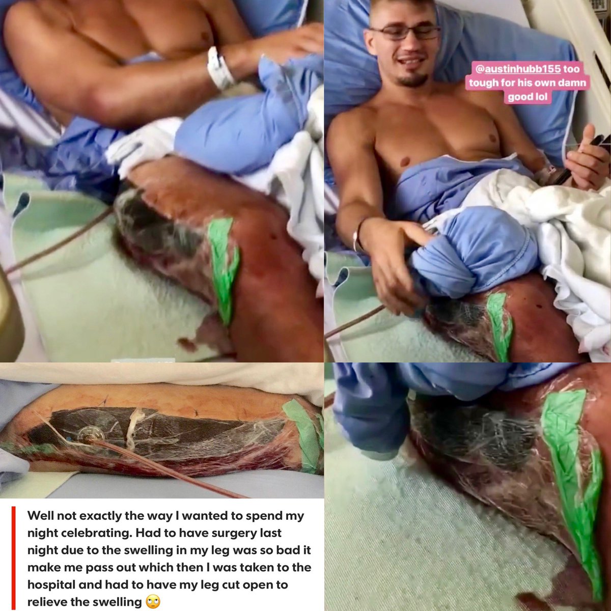 MMAsubPodcast's tweet photo. #AustinHubbard's leg was cut open due to severe swelling after his win he was taken to a local hospital where he underwent a procedure to relieve the pain
#UFC #MMA #DanaWhite #UFCVancouver #ESPN #ESPNPLUS #UFCFightNight #fightniight158: #Vancouver #CowboyvsGaethje https://t.co/EGeeyqb1Ci