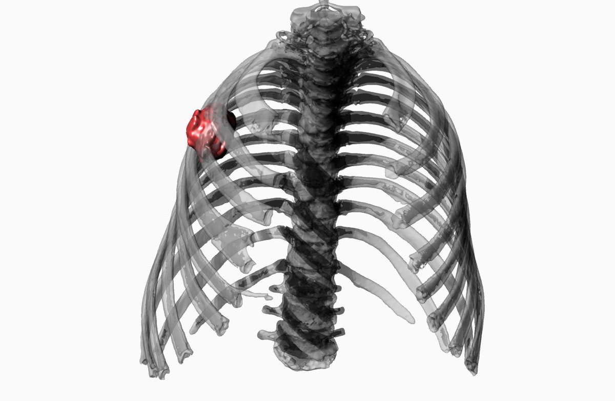dqbito's tweet photo. Paciente masculino que presenta un hemangioma abrazando la tercera costilla, se realiza la reconstrucción para visualizar la afectación
Los hemangiomas pueden ser definidos como anomalías del desarrollo del tejido vascular, típicamente de carácter benigno. https://t.co/pGM9v4DnnY