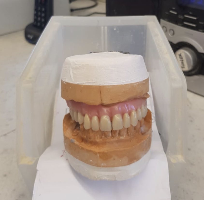 Full upper acrylic denture @ the try in stage 😁🙌🏽🔬 #fullupper #actylic #denture #dentures #dental #dentist #dentistry #dentaltechnology #creatingsmiles2019 #smileagain #denturework #smile #cosmeticdentistry #cosmeticdental