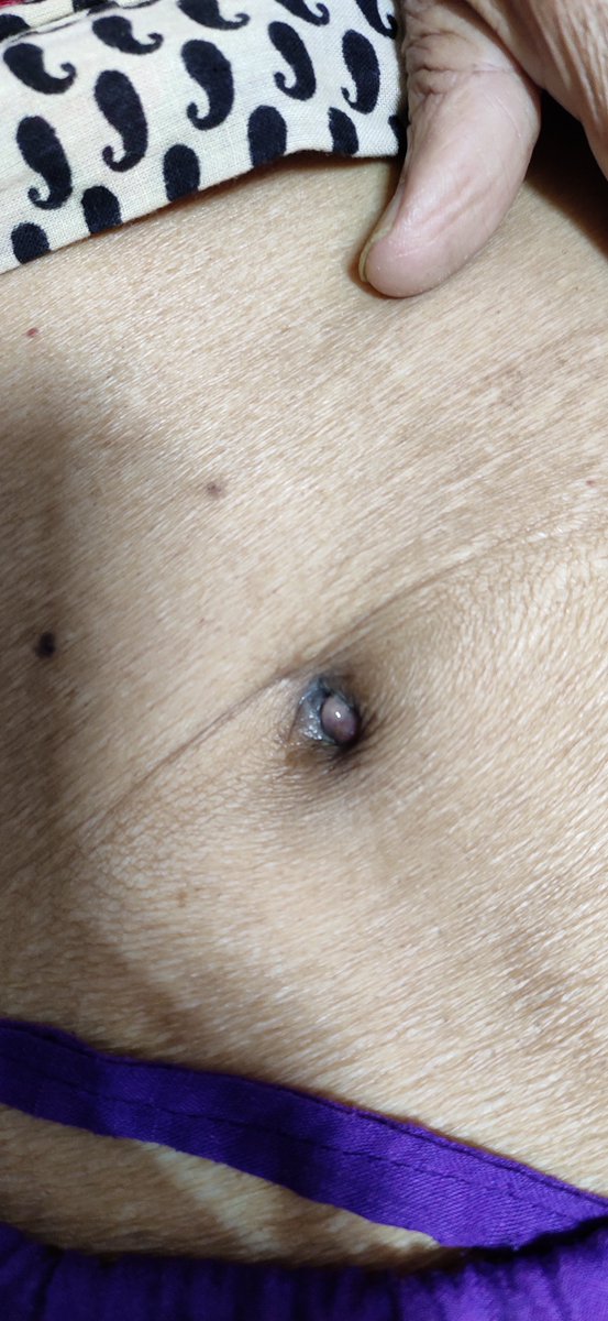 Dr Sanchayan Mandal En Twitter Sister Mary Joseph Nodule In My Patient Https T Co Jzhayb6c4a Twitter