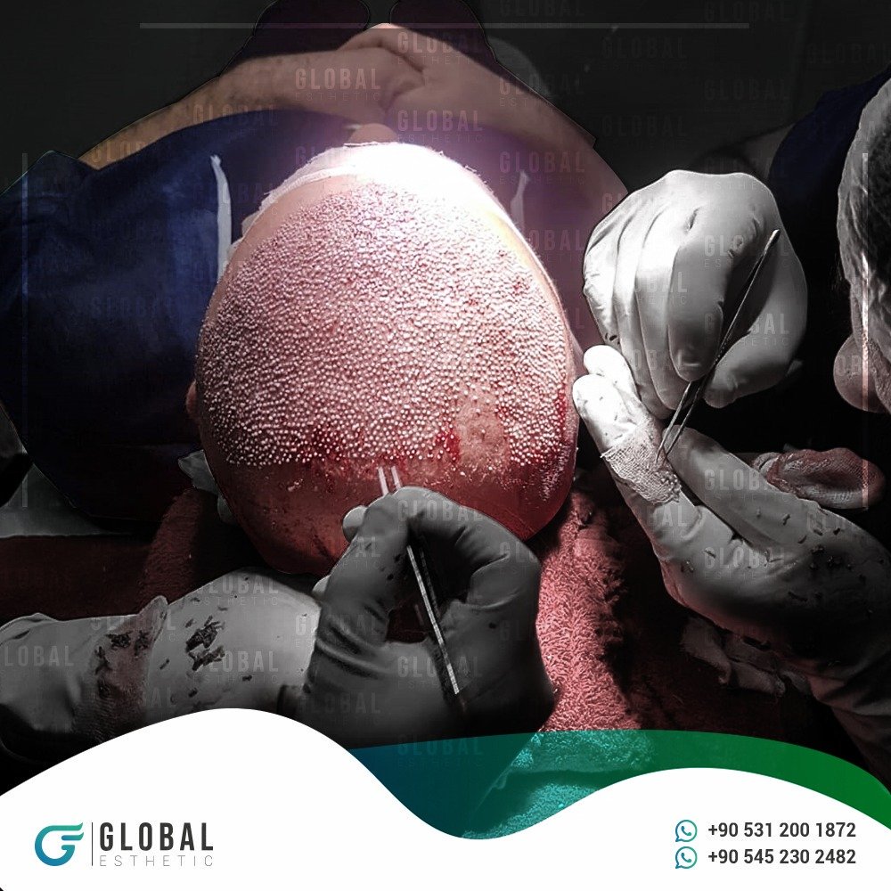 global_esthetic's tweet photo. مركز GLOBAL ESTHETIC يقدم لكم معلومات عن عدد البصيلات التي يحتاجها المريض في عملية زراعة الشعر👇

هيا نحن بانتظارك للتواصل والاستفسارات عبرالواتس اب 👇

https://t.co/0fh5R5FddK

https://t.co/u6OD6CXEzI

00905050556974 - +00905312001872

#زراعهالشعر #زراعهشعر #زراعه_الحواجب https://t.co/sr4zFRtPWV