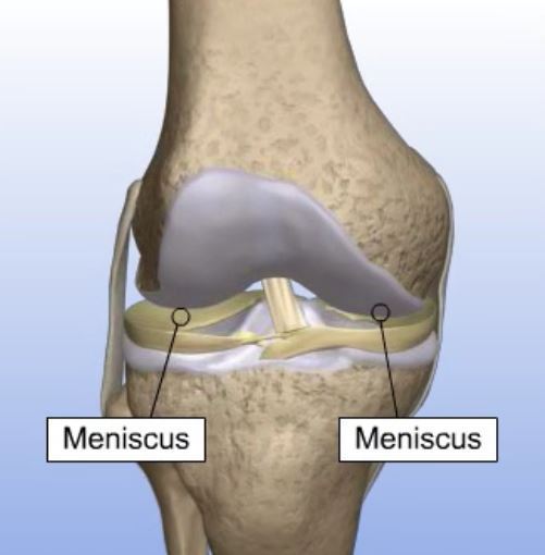 What is meniscal transplant surgery? sportsmedicineweekly.com/2019/09/16/wha…