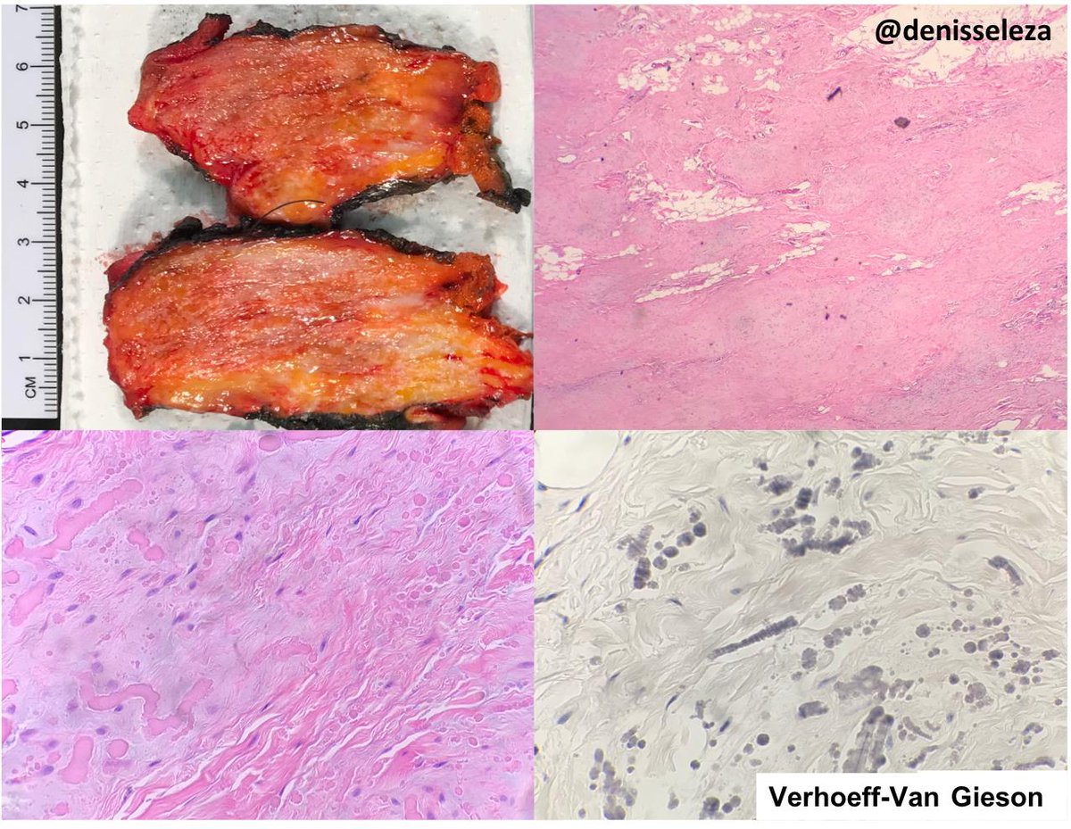 Elastofibroma: Gross: Fibrous areas interposed with adipose tissue. Low power: Elastic fibers within a collagenous stroma admixed with adipose tissue. High power and  VVG stain: Elongated and globoid elastic fibers with a dense core (beads on string). @denisseleza