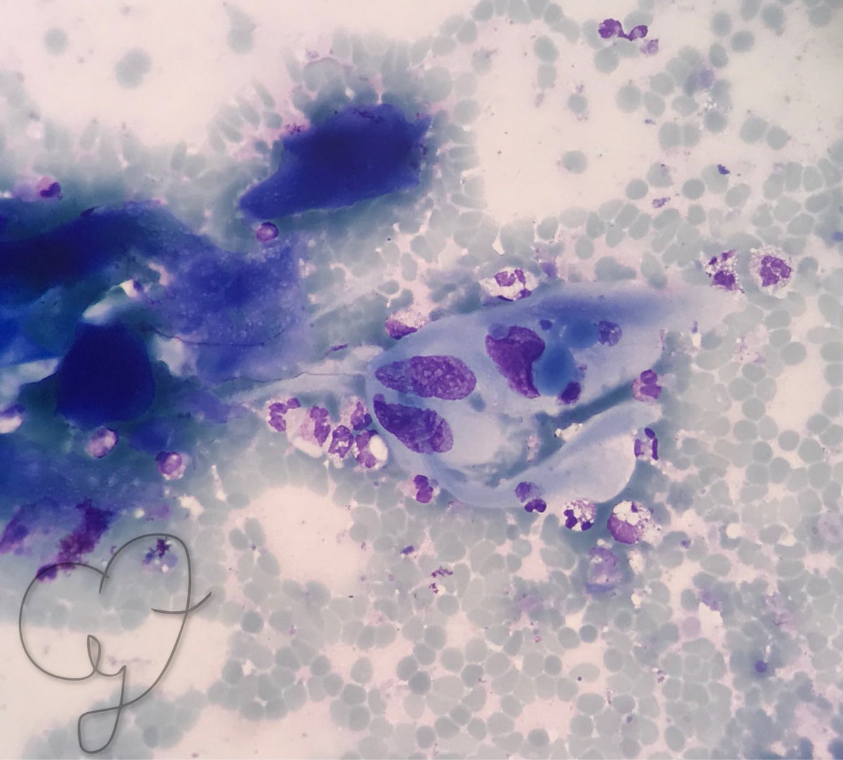 CytZoom's tweet photo. Squamous cell carcinoma of the bladder
• lavage bladder 
•Pat. 80 years old, hematuria
Only about 5% of bladder cancer in Europe and in the US are squamous cell carcinomas, they are more likely to occur in endemic areas of schistosomiasis
* Most keratinising squamous carcinomas https://t.co/gtexNU5Yan