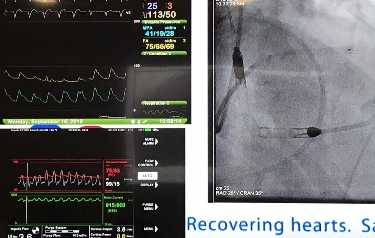We had the pleasure of hosting some awesome operators today from around the continent who helped us do several high risk MCS cases successfully that included PercAx, Single Access, FFR, IVUS, CTO, multivessel PCI, and complete revasc.  Big shout to the attendees and our faculty.