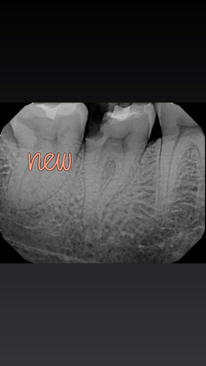 DrRicoShort's tweet photo. The SHORT Case of The Day!
Tooth #31 - I “C” You
This tooth had C -Shaped anatomy. It was first documented by Cooke and Cox in 1979. The prevalence of C-shaped root canal reported to ranges from 2.7% to 44.5% in mandibular second molars.
#WorthSaving #DrRicoShort #RootCanalsRock https://t.co/PGsHj2qJKr