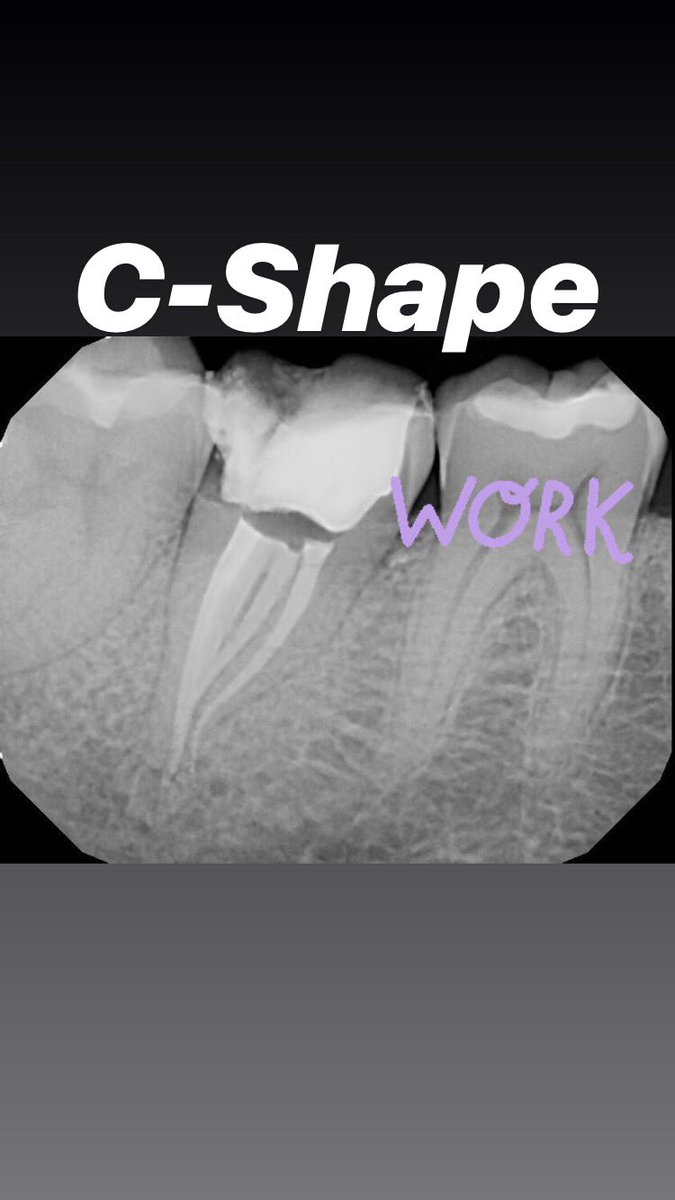 DrRicoShort's tweet photo. The SHORT Case of The Day!
Tooth #31 - I “C” You
This tooth had C -Shaped anatomy. It was first documented by Cooke and Cox in 1979. The prevalence of C-shaped root canal reported to ranges from 2.7% to 44.5% in mandibular second molars.
#WorthSaving #DrRicoShort #RootCanalsRock https://t.co/PGsHj2qJKr