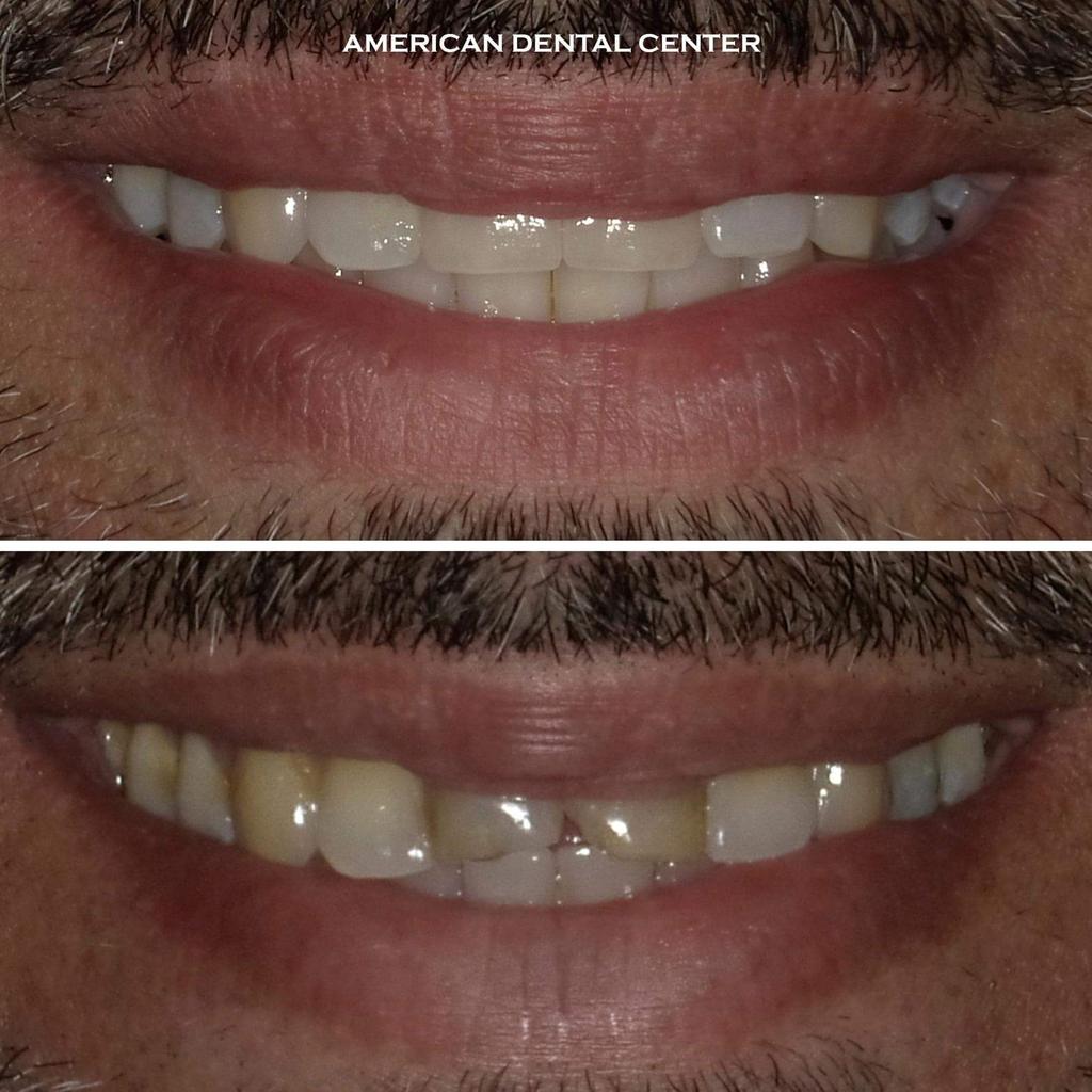 adcmuscat's tweet photo. Created in our top of the range on-site laboratory, these two central crowns have transformed his smile and ensured another happy ADC patient.
#adcoman #adcmuscat #americandentaloman #oman #عمان #مسقط #طبيب_اسنان_عمان #طبيب_اسنان_مسقط #طبيب_اسنان #اعتني_باسنانك #عناية_الاسنان https://t.co/P5HqefuSOS