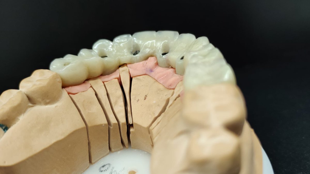#implantbridge 😍
#temporaryacrylic 🙌🏽
#temp 👍🏽
#screwretained 🔩
#bigcase 💪🏽
#step1 🦶🏼
#cosmetic 😄
#restorative  🦷                                      #dentaltechnology 🔬                              #cosmeticdentistry 😁                           <a href="/optimum_dental/">Optimum Dental Lab</a>.